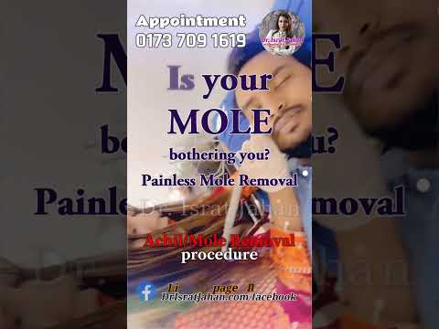 Achil or Mole Removal - আচিল বা তিল না রেখে ফেলে দেয়া স্বাস্থ্যের জন্য ভালো 