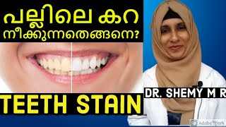 How to remove TEETH STAIN (2021)_with Eng subs || പല്ലിലെ കറ (in Malayalam) || Dr. Shemy M R