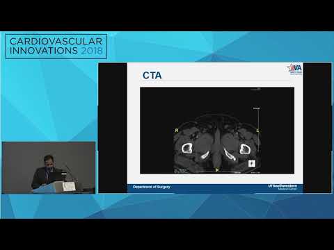 CVI2018 Session: Simultaneous Aortobifemoral and Femoral to Popliteal Bypass - Vikas S. Gupta, MD