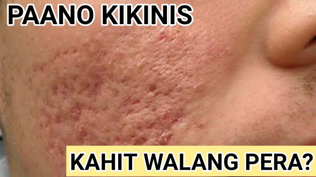 BUROG NA MUKHA PAANO KIKINIS KAHIT WALANG PERA PANG LASER