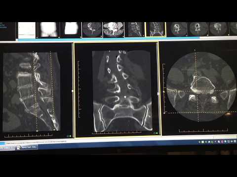 CT pictures of a patient with Scoliosis 41 degrees (preop)