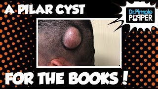 A Pilar Cyst for the Books