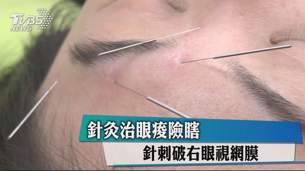 針灸治眼痠險瞎 針刺破右眼視網膜