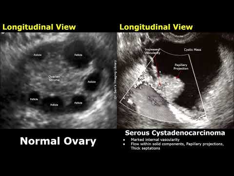 Gynecological Ultrasound Ovary Normal Vs Serous Cystadenocarcinoma | Ovarian Cancer USG Findings