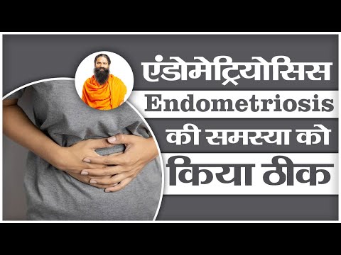 एंडोमेट्रियोसिस (Endometriosis) की समस्या को किया ठीक || Swami Ramdev