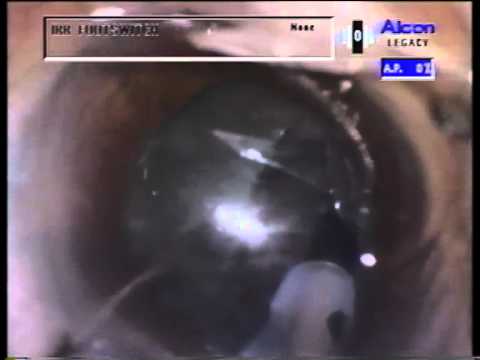 Brunescent Cataract Extraction By Dr Gimbel