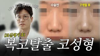 코실 제거 후 복코 해결! 콧대와 코끝 개선으로 세련된 7개월 경과 코성형 케이스리뷰 (실리콘 + 비중격 연골)