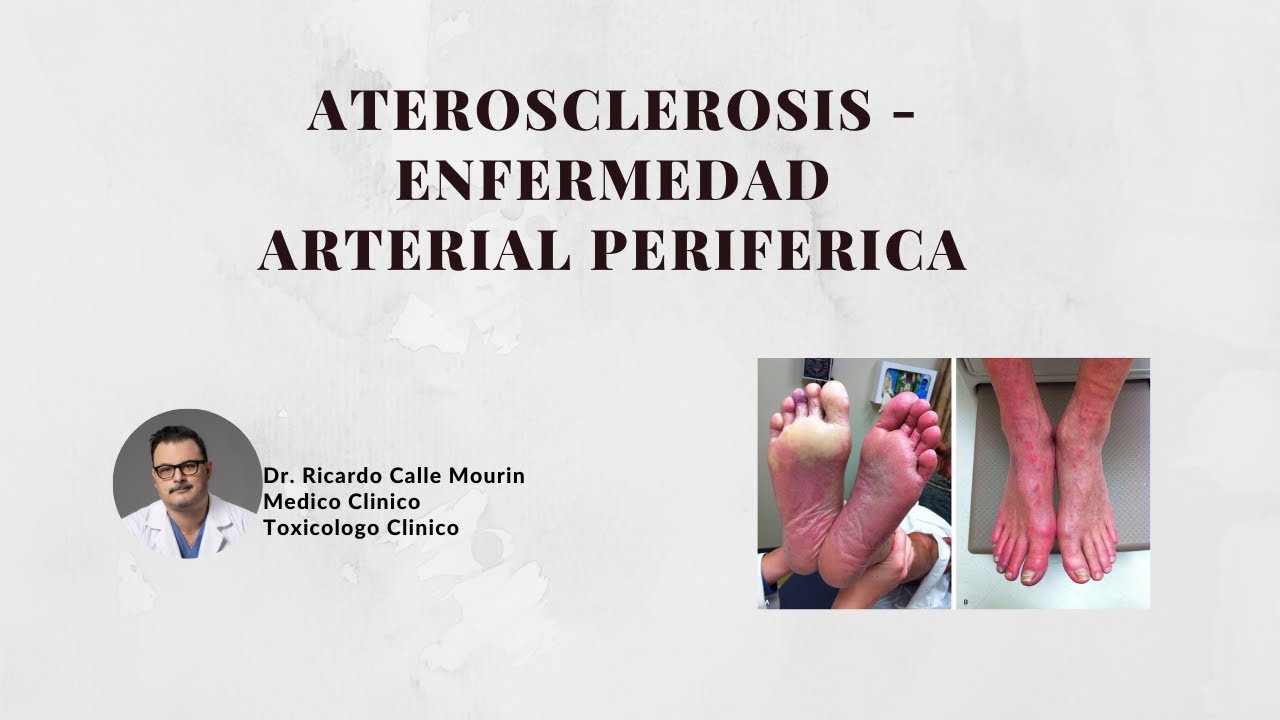 Aterosclerosis y Enfermedad Arterial Periferica: Principales sintomas y manifestaciones
