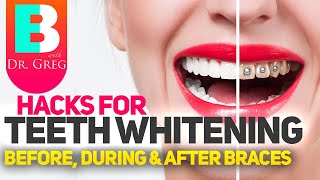 Braces Hacks to Keep Your Teeth White | Teeth Whitening with Braces and Invisalign