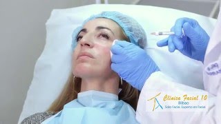 Relleno de pómulos con ácido hialurónico (Restylane Perlane) en Bilbao