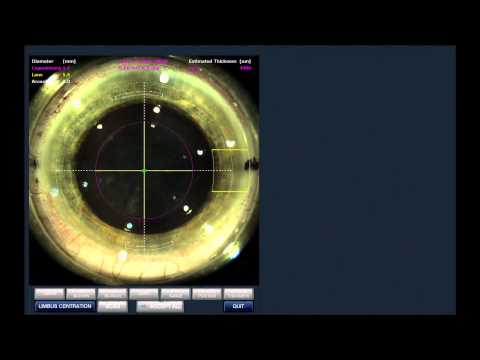 Stephen Slade MD LIVE Laser Cataract Surgery (Laser Only)