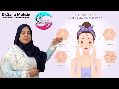 Learn About Melasma & Hyperpigmentation - What It Is, Causes, and Treatments