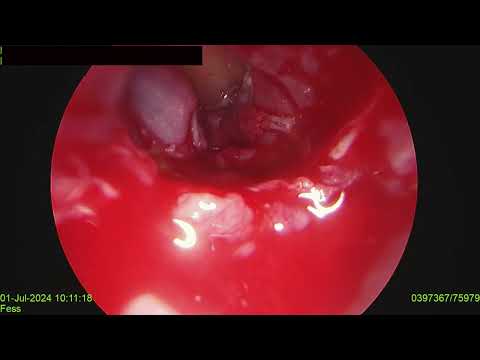 REVISION FESS IN ALLERGIC FUNGAL RHINOSINUSITIS WITH POLYPOSIS