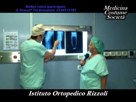Osteocondrosi prezentatsіya su movі ukraїnskіy Lussazione dellarticolazione della spalla complicata
