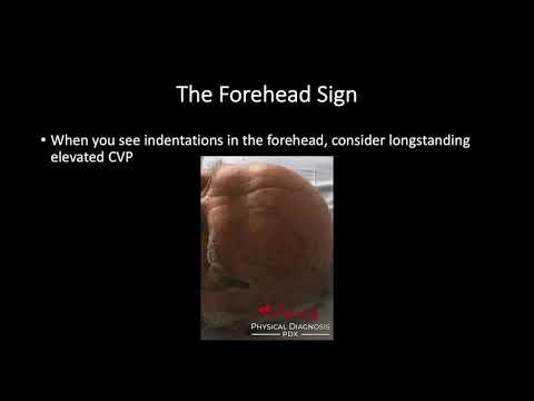 Jugular Venous Pulse: Quantitative Assessment