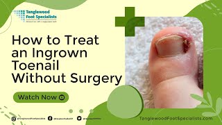 How to Treat an Ingrown Toenail Without Surgery