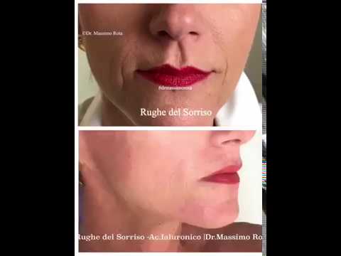 Il photoepilation o il laser epilation per la persona, quello che è migliore Maschera durante un secolo mobile