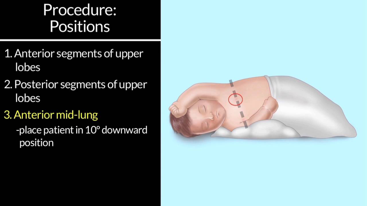 Chest Physiotherapy by S. Hamilton | OPENPediatrics
