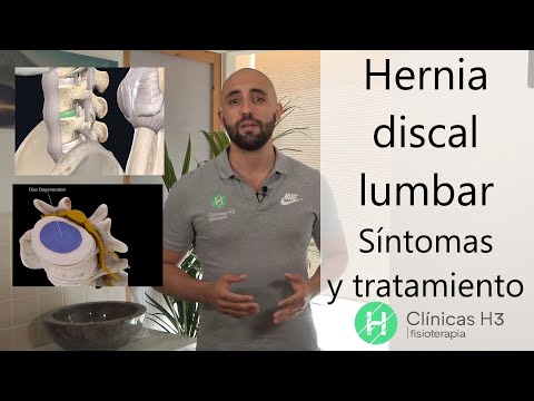 Hernias discales lumbares. 🙍 Sintomas hernia discal lumbar - [2021]
