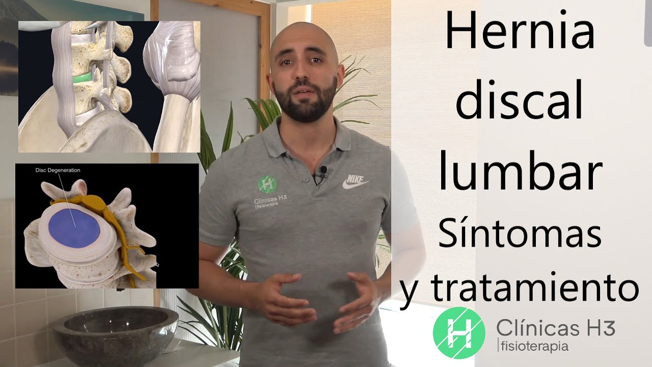 Hernias discales lumbares. 🙍 Sintomas hernia discal lumbar - [2021]