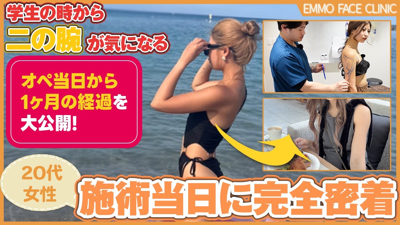 【二の腕脂肪吸引】「脂肪吸引を受けたお客様の声を聞いて私もしたくなった」当院の看護師が二の腕脂肪吸引に挑戦！