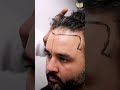 Indian Cricket Legend Parthiv Patel S Hair Restoration Journey With MedLinks