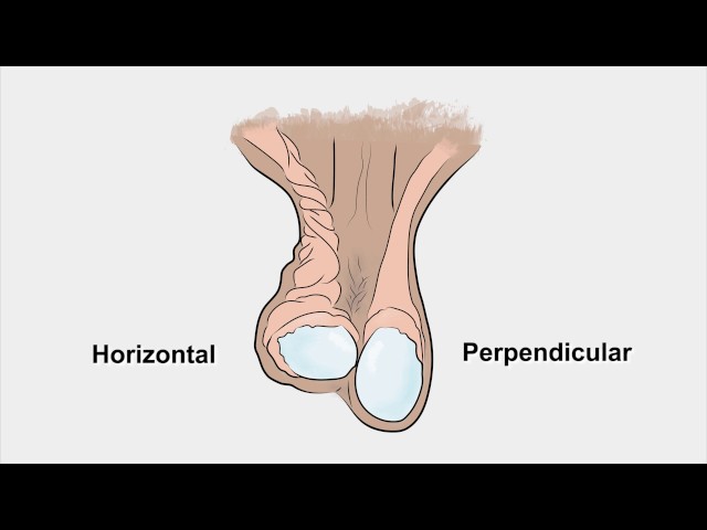 Video Pronunciation of epididymo-orchitis in English Video Pronunciation of epididymo-orchitis in English