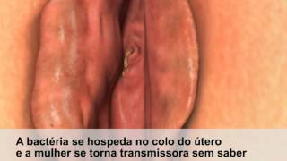  Gonorréia e Herpes Genital
