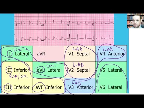 How to Interpret STEMI 12 Lead ECG and Correlate it with Coronary Arteries, 15 Lead EKG, Part 1