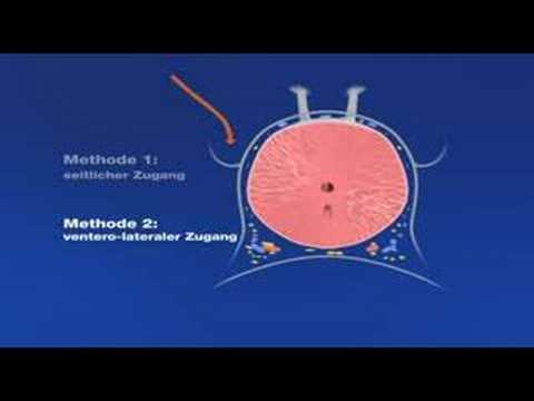 Beide sind Steine in der Prostata genannt Wie ist Prostatahyperplasie