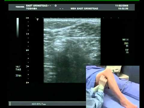 Popliteal Block (Ultrasound guided) - lateral approach