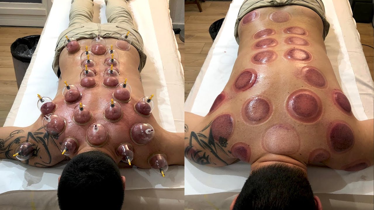 Watch video ??LES VENTOUSES CHINOISES, ÇA FAIT MAL  ??LES VENTOUSES CHINOISES, ÇA FAIT MAL