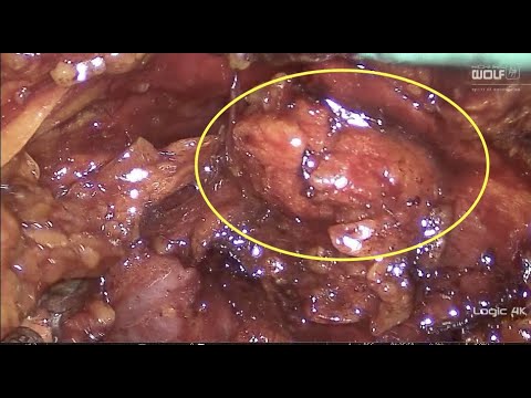 Retroperitoneoscopic enucleation of renal tumor