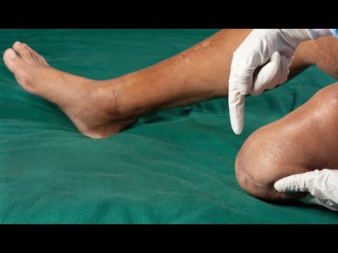 What is Phantom Limb Pain?