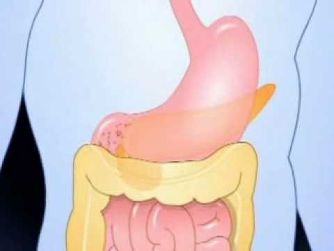 Diabetes mellitus 2 típusú dekompenzáció kezelése