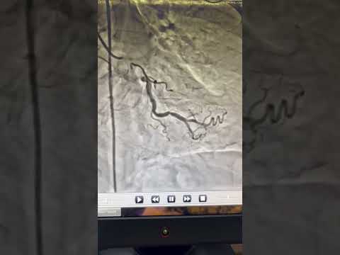 What is CTO(CHRONIC TOTAL OCCLUSION) | Cradiologist | Dr. Ankit Gupta | Read Full Description