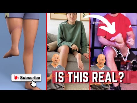 "ROTATED" Leg Amputation #surgery