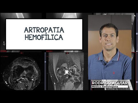 Artroza articulațiilor vertebrale arcuite și costale