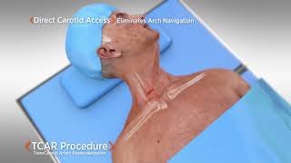 TCAR | TransCarotid Artery Revascularization Procedure Narrated Animation | Silk Road Medical | 4min