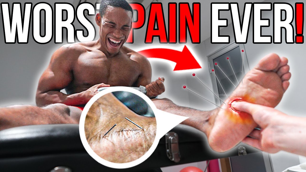 The WORST PAIN! | Fixing 28 YEARS Of Flat Feet w/ NEEDLES