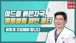 ENG)여드름 붉은자국, 패인흉터는 어떻게 치료하는지 다 알려드림 feat. 여드름흉터 단계별 치료방법, 레이저 총정리