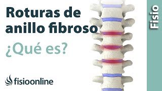 Roturas anulares o del anillo fibroso discal - ¿Qué es