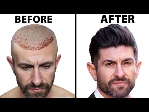 What's It Like To Get A Hair Transplant? | Hair...