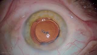 Dr.Stanimir Troshev Cataract Surgery Livestream