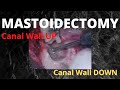 068 Canal Wall UP Canal Wall DOWN Mastoidectomy Mastoid Surgery Hearingimpaired