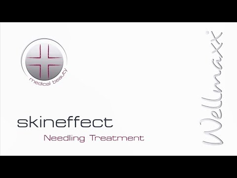 Micro-Needling Gesichtsbehandlung im WELLMAXX beauty spa Köln/Hürth