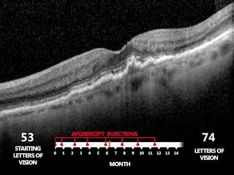 Feuchte altersbedingte Makuladegeneration