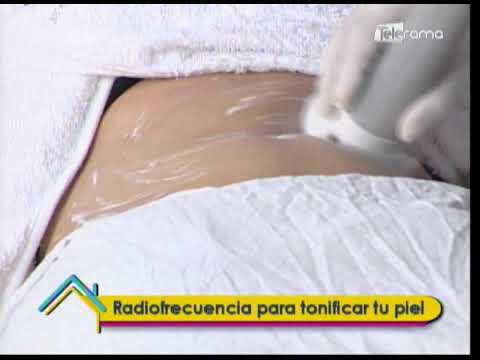 Radiofrecuencia para tonificar tu piel