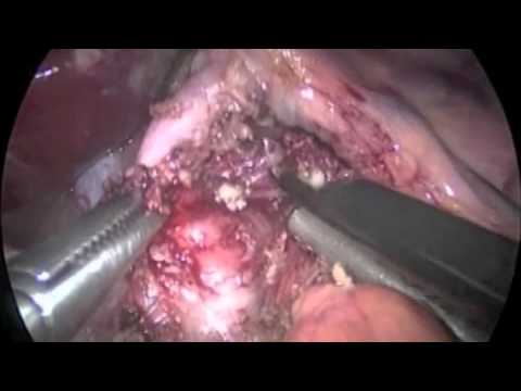 Experience with Laparoscopic Median Arcuate Ligament Release in 36 Patients