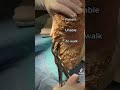 Severe Callus Removal In Operating Room Shorts